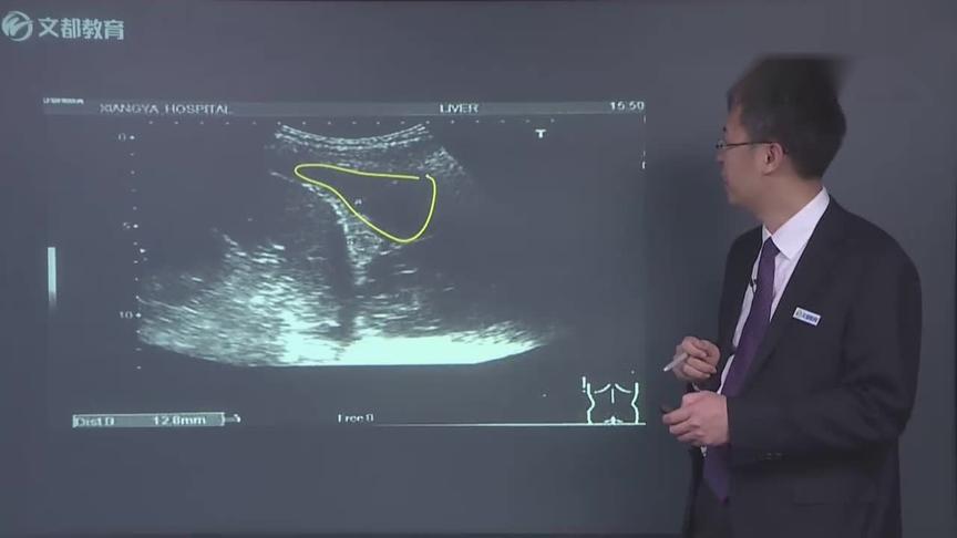 [图]医学影像诊断：胸腔积液的超声诊断