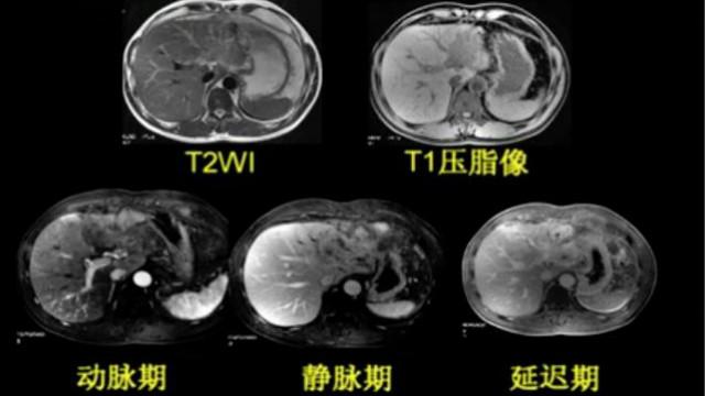 [图]影像诊断：腹部疾病影像诊断（上）