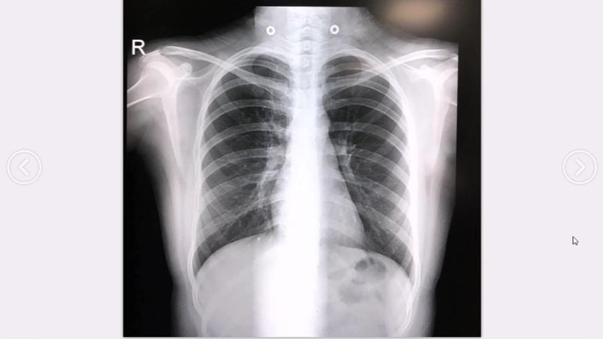 [图]胸部X线平片解剖详细讲解，干货，初学者实用
