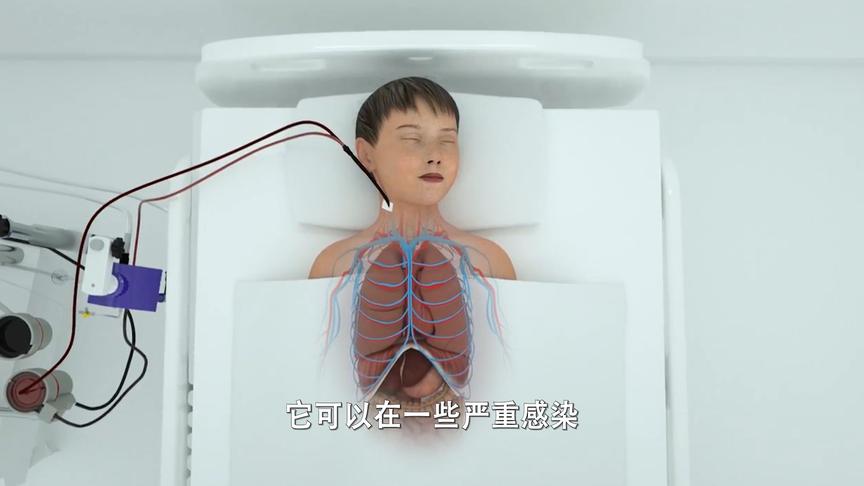 [图]ECMO（体外膜肺氧合）是如何为心脏或肺部提供生命急救支持的