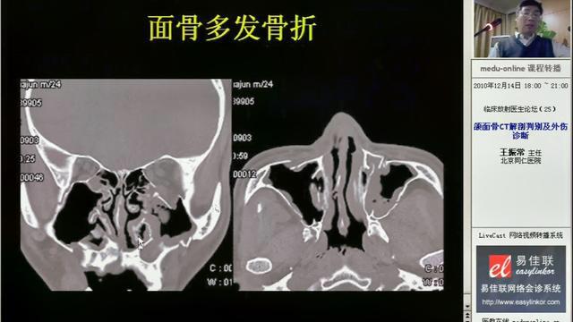 [图]【CT诊断学】颌面骨及颅底解剖的CT识别及外伤诊断