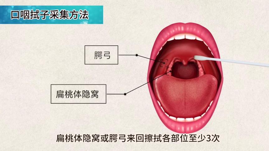 [图]新型冠状病毒核酸检测-口咽拭子采集流程视频