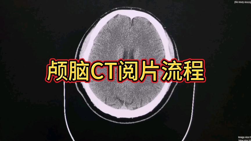 [图]让放射科医生带你了解颅脑CT能看到那些疾病？颅脑CT阅片的流程！