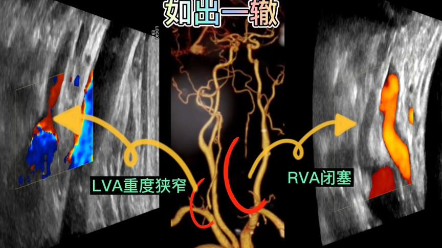 [图]#颈部血管超声，基层医院没有TCD和TCCD，该如何做好颈部血管超声