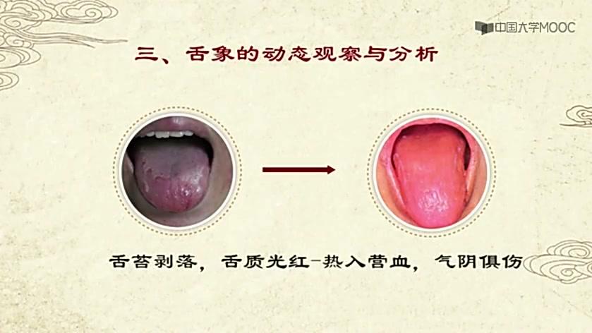 [图]中医诊断学：第四周望诊-3：舌诊-舌象分析要点