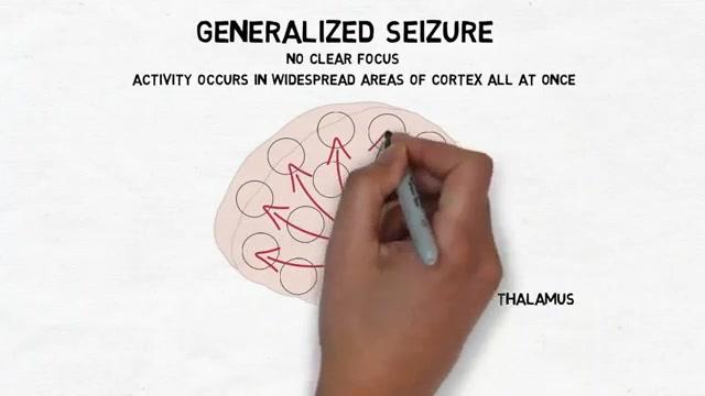 [图]两分钟介绍神经科学系列—癫痫