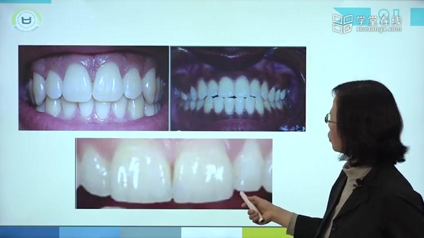 [图]【口腔解剖】第二章 牙体解剖生理-上颌切牙