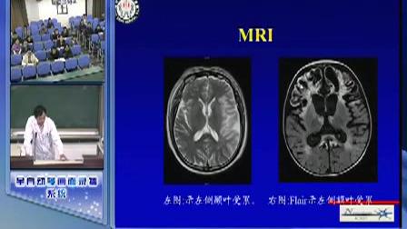 [图]神经病学 9 中枢神经系统感染