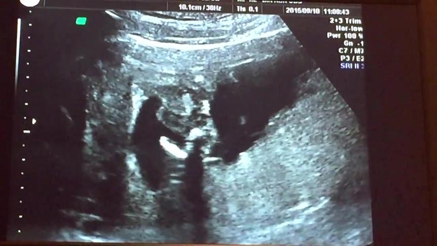 多少周做b超可以看出性别 西瓜视频