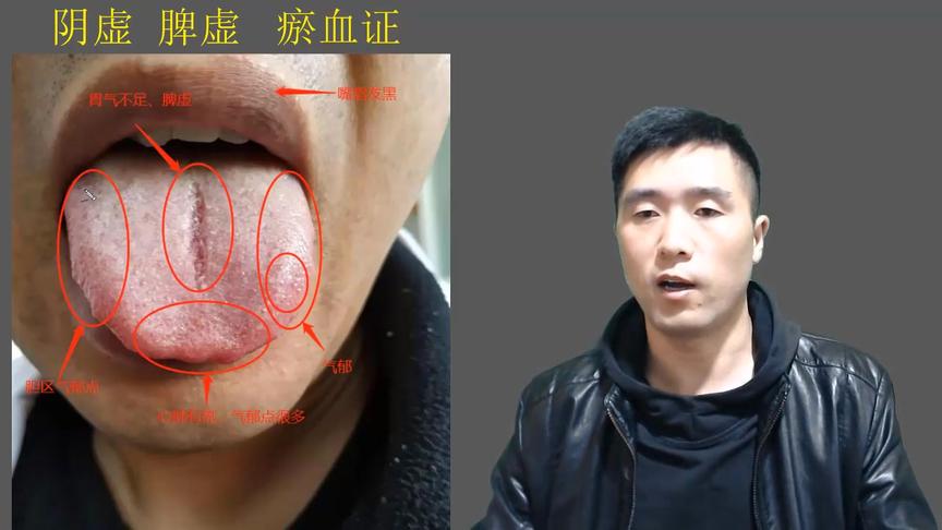 舌根苔厚腻是什么原因 西瓜视频