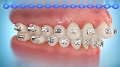 牙齿矫正怎么收缝 西瓜视频