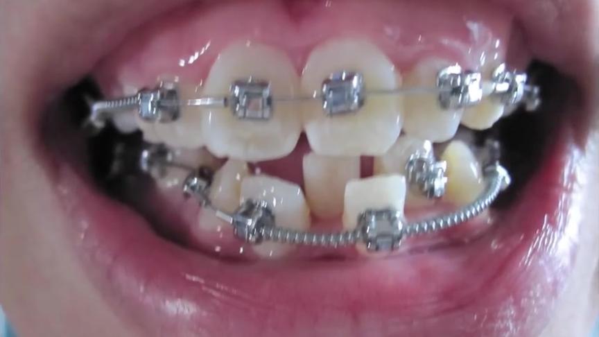 牙套矫正内侧 西瓜视频